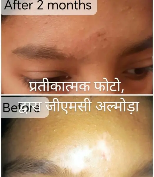 सफेद दाग(vitiligo) के रोगियों की लिए बड़ी उम्मीद,अल्मोड़ा मेडिकल कॉलेज के त्वचा रोग विभाग में हुआ सफेद दाग का सफल ऑपरेशन 2 vitiligo