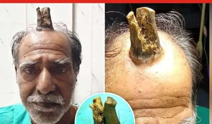 When a man got injured on his head, a horn came out instead of blood, he got tired of biting it and went to the doctor